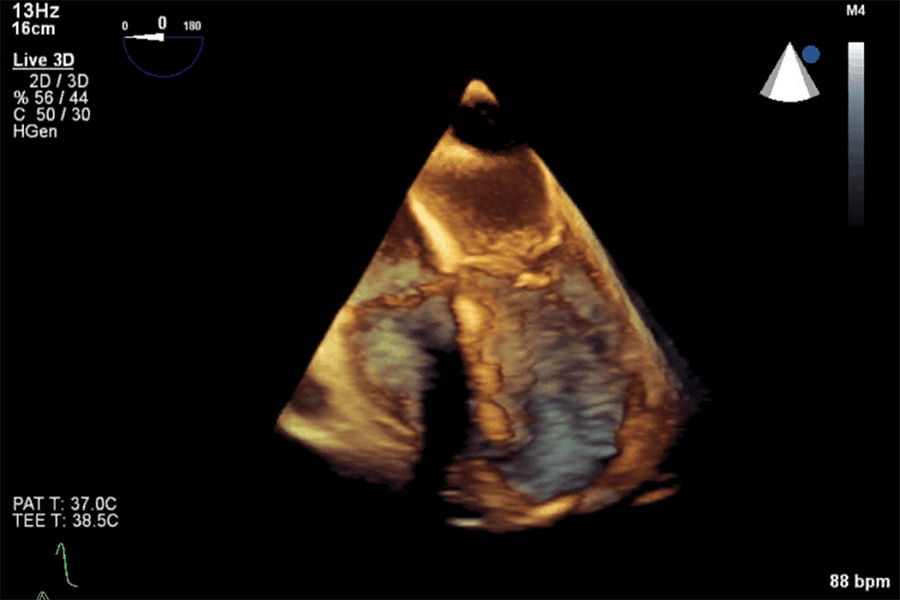 cardiac ultrasound