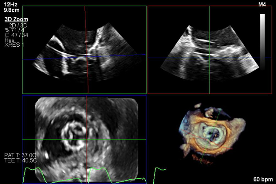 Exercise echocardiography