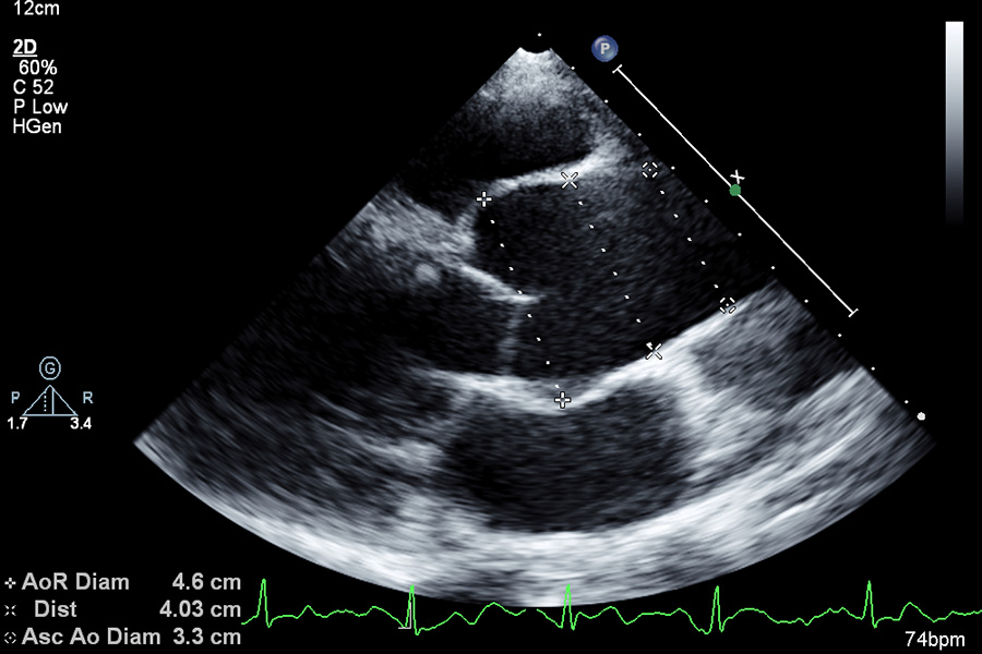 cardiac ultrasound