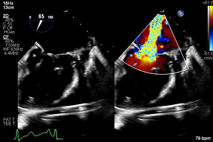 Echocardiography including specialised assessment for structural heart disease